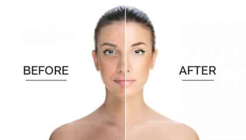 chemical peels before and after