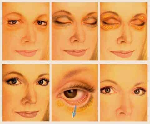 Eyelid Surgery