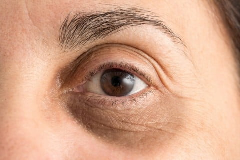 Dark Circles