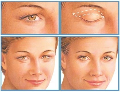 Droopy Eyelid