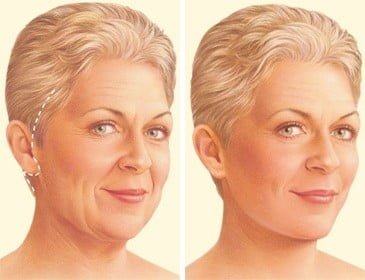 Facelift Procedure
