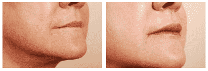 Permanent Lip Augmentation Surgery in Hyderabad