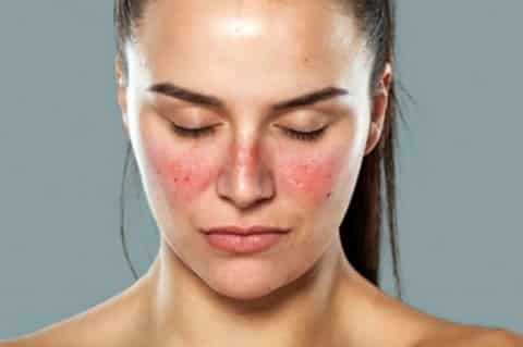 Lupus Treatment in Hyderabad