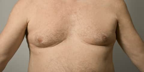 Understanding Man Boobs