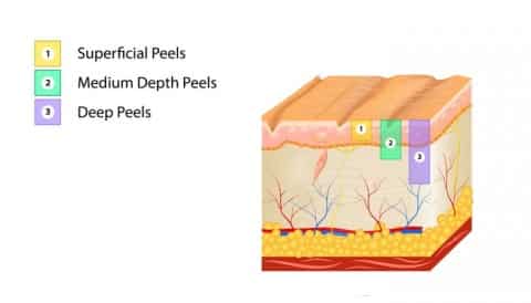 types of chemical peels