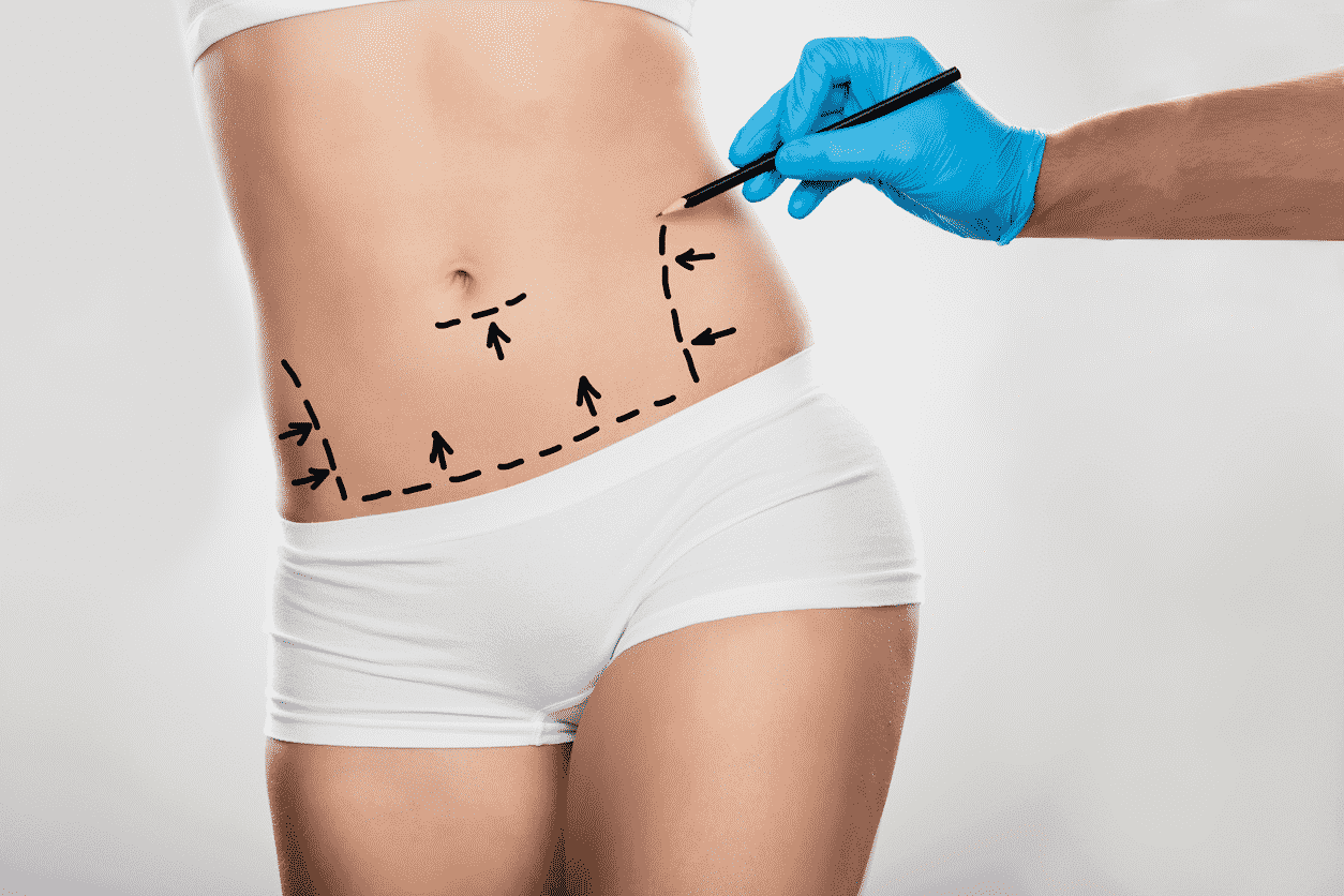 Abdominoplasty Surgery: Treatment, Procedure And Results Abdominoplasty Surgery: Treatment, Procedure And Results