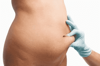 Tummy Tuck vs. Liposuction - Which To Prefer? Who?