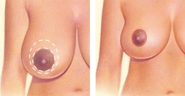 Breast Reduction: Treatment, Procedure, And Results