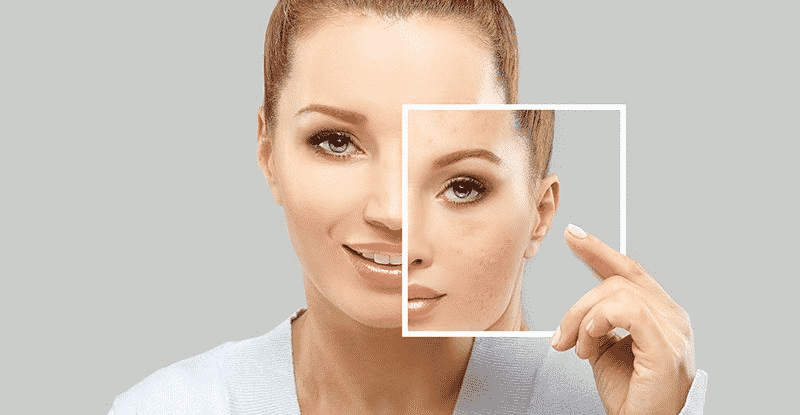 Acne Scar Treatment