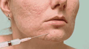 Acne Scar Treatment