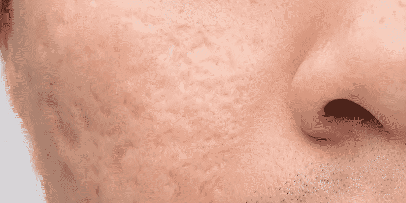 Acne Scar Treatment