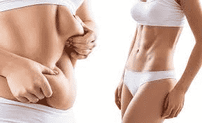 Tummy Tuck vs. Liposuction - Which To Prefer? Who?