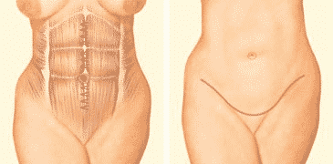 Abdominoplasty Surgery: A Complete Answer Guide To Your Every Question