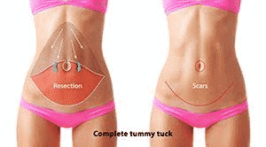 Tummy Tuck vs. Liposuction - Which To Prefer? Who?