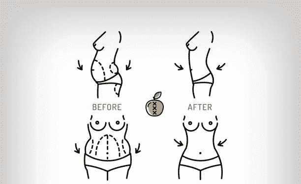 Abdominoplasty Surgery: A Complete Answer Guide To Your Every Question