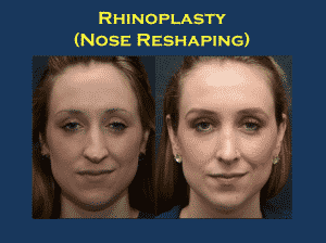Top 10 Benefits of Breast Augmentation Rhinoplasty Surgery: A Complete Guide to Nose Surgery Benefits, Treatment, Cost and Results