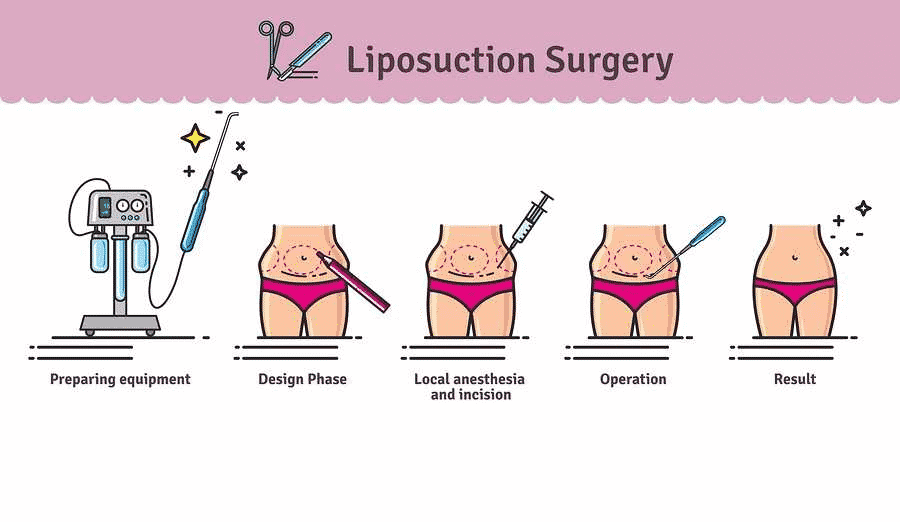 Tummy Tuck vs. Liposuction - Which To Prefer? Who?