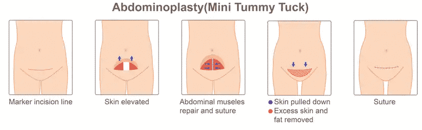 Abdominoplasty Surgery: A Complete Answer Guide To Your Every Question