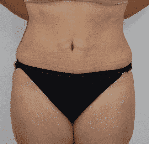 Abdominoplasty Surgery: Treatment, Procedure And Results Abdominoplasty Surgery: Treatment, Procedure And Results