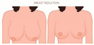 Breast Reduction: Treatment, Procedure, And Results
