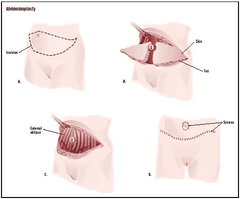 Tummy Tuck vs. Liposuction - Which To Prefer? Who?