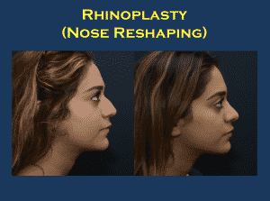Top 10 Benefits of Breast Augmentation Rhinoplasty Surgery: A Complete Guide to Nose Surgery Benefits, Treatment, Cost and Results