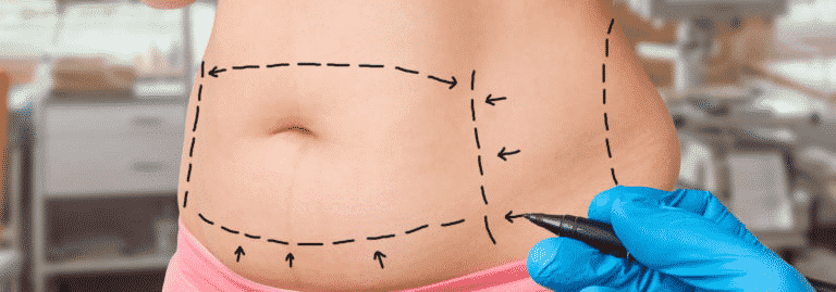 Abdominoplasty Surgery: A Complete Answer Guide To Your Every Question