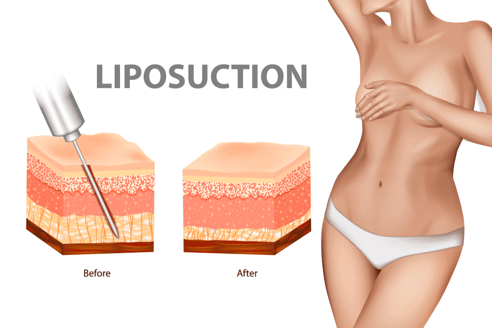 Tummy Tuck vs. Liposuction - Which To Prefer? Who?