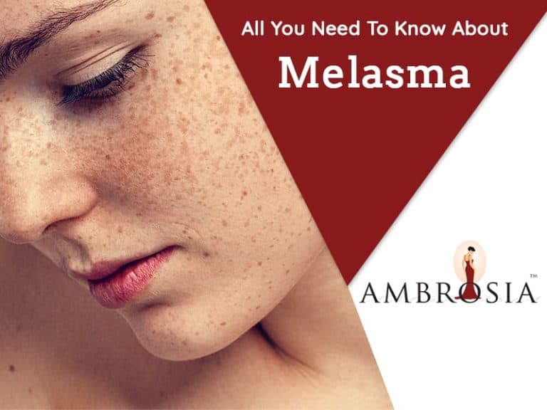 All You Need To Know About Melasma