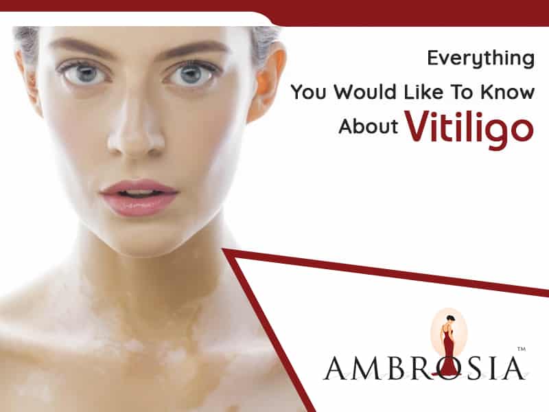 Here's Everything You Would Like To Know About Vitiligo?