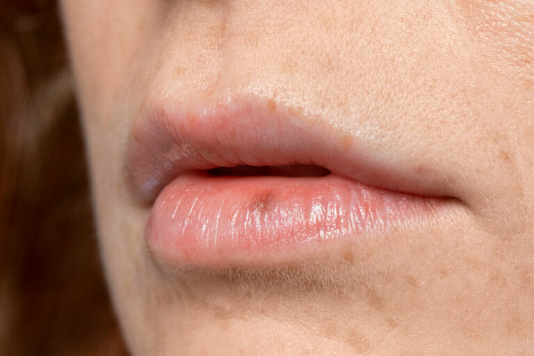 How to Get Rid of a Pimple on Your Lip