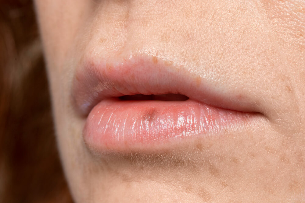 How to Get Rid of a Pimple on Your Lip