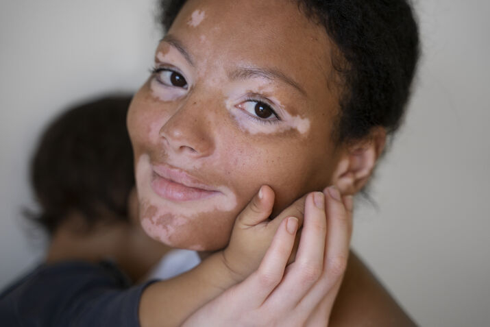 lady suffering from vitiligo disease