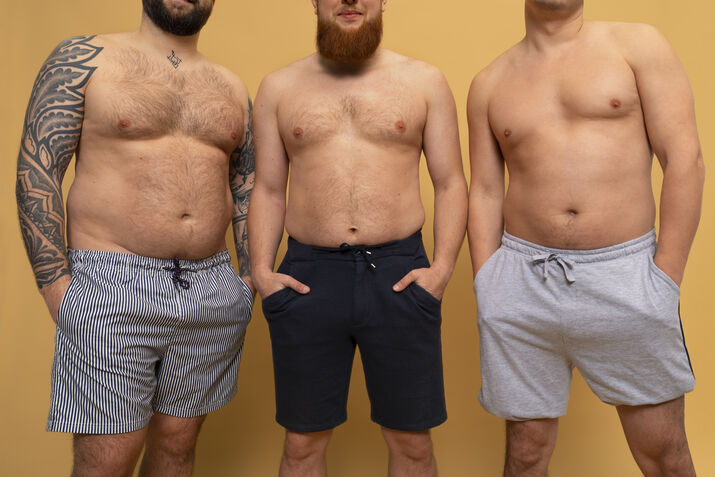 3 men in different gynecomastia stages
