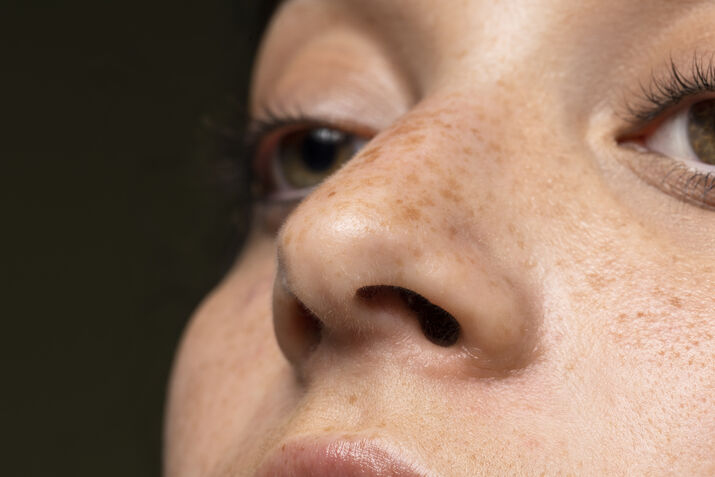 woman suffering from melasma