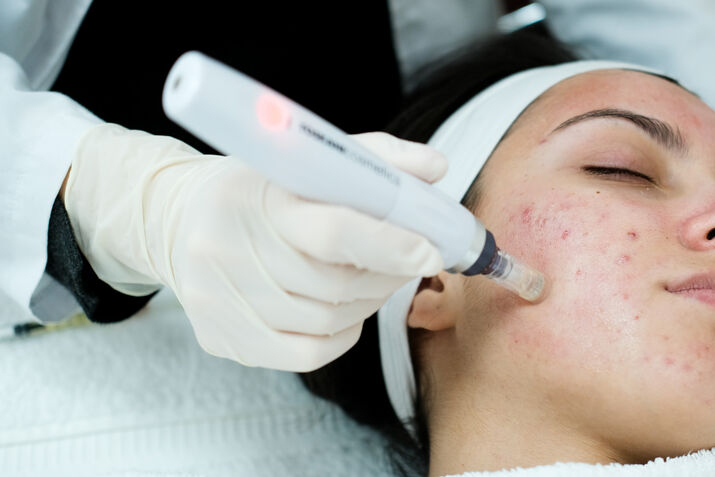 microneedling for acne scars procedure
