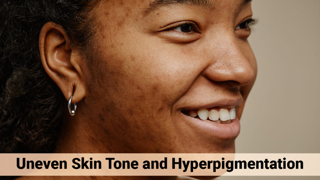 The Best Solutions For Uneven Skin Tone And Hyperpigmentation