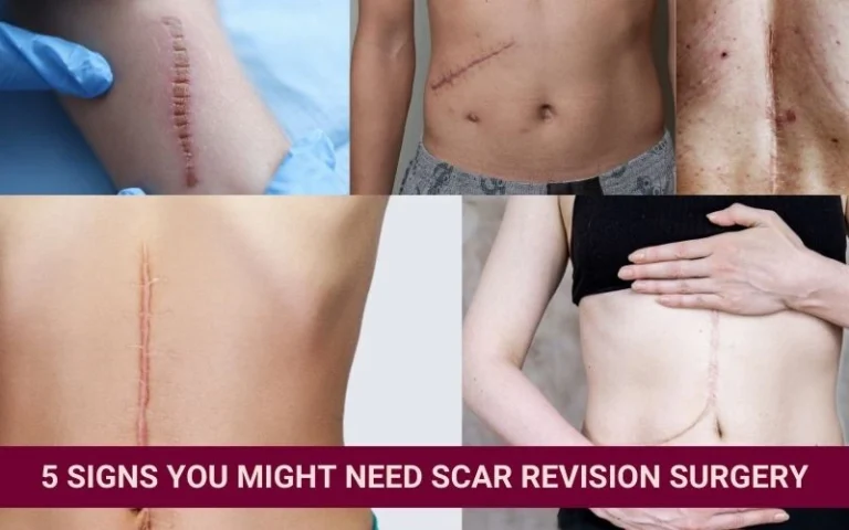 Complete Guide To Scar Revision Surgery (Old Scar Removal & Correction)