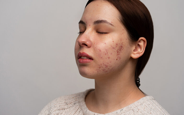 acne problem treatments