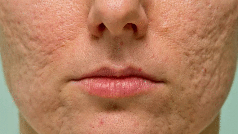 Choosing Acne Scar Treatment By Skin Tone (Fitzpatrick Guide)