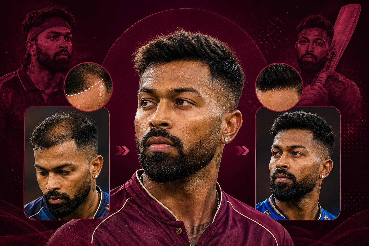 Hardik Pandya Hair Transplant: A Modern Celebrity Grooming Story